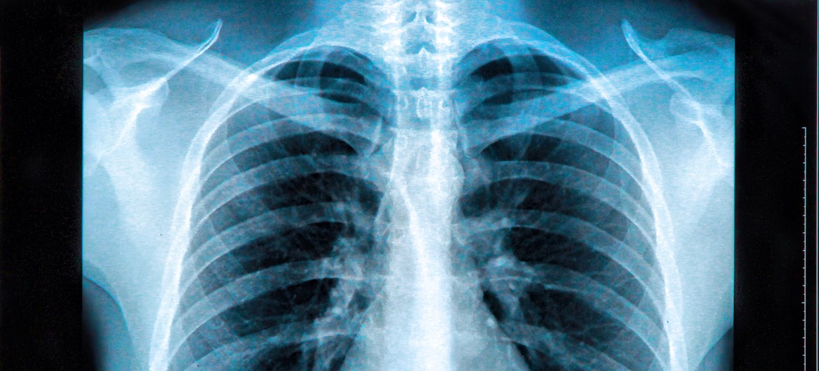 Digital chest X-ray image