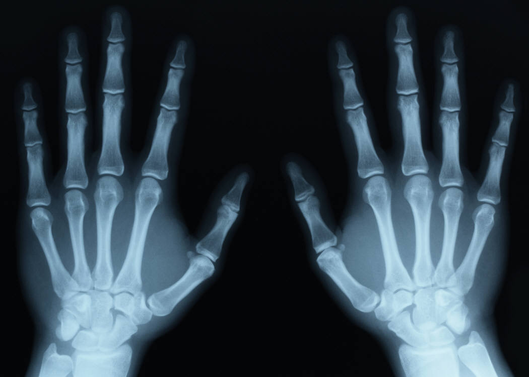 Digital X-ray image of two hands